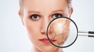 Cildiniz su diye haykırıyor! Kuruluk ve pullanma alarmı