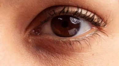 Evde göz altı morluklarını geçirebilecek doğal yöntemler