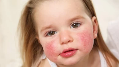 Alerji artışına sezaryen etkisi! Uzmanlar uyarıyor