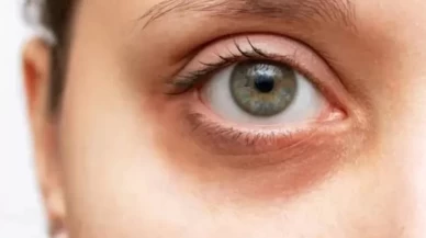 Hangi kremler göz altı morluklarını azaltır?