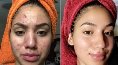 Cilt lekelerine veda ettiren en önemli ürünler