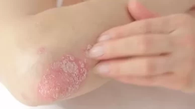 Sedef hastalığında beslenmenin rolü! Bu gıdalardan uzak durun