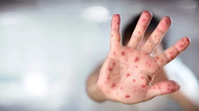 ABD’de kızamık vakaları 33 yılın zirvesinde