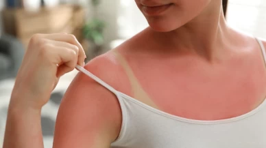 Güneş yanığını önemseyin! Kansere sebep olabilir!