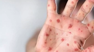 Gana'da M çiçeği vaka sayısı 197'ye yükseldi