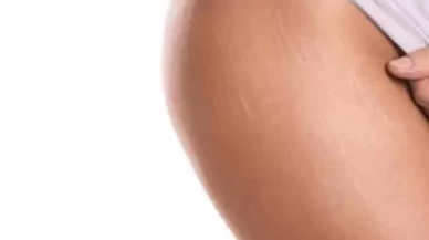 Vücut çatlakları için hemen uygulayabileceğiniz basit çözümler