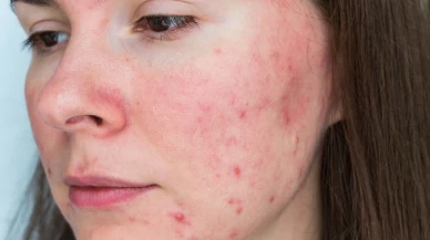 Yüzdeki kızarıklıkların sebebi gül hastalığı olabilir!