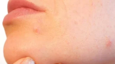 Hamilelikte cilt sorunlarıyla başa çıkmanın 5 doğal yolu