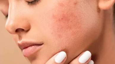 Cilt Lekelerine Karşı En Yeni Tedavi Yöntemleri