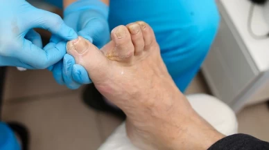 Ayak Mantarıyla Savaşın: Elma Sirkesi ve Karbonatın Etkili Kullanım Yöntemleri!