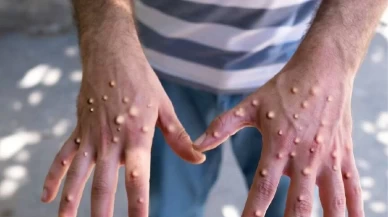 Afrika'da M çiçeği virüsü alarmı!