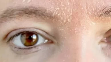 Pul pul kuruluk ve yağlanma! Sonbaharda cilt nasıl dengelenir?