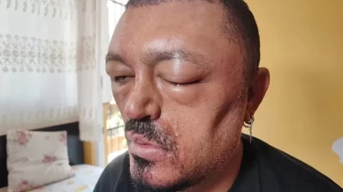 Siyah saç şampuanı kör ediyordu