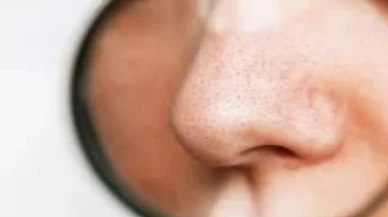 Siyah nokta temizliğinde çığır açan doğal yöntem! Herkes bu maskeyi konuşuyor