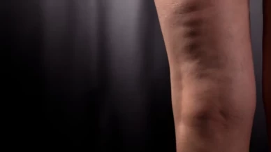 Kadınların korkulu rüyası lipödemde büyük yanılgı