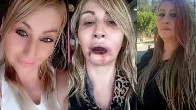 Dolgu sonrası dudağını kaybetti! 'Gülüşüm yok, yemek yiyemiyorum'