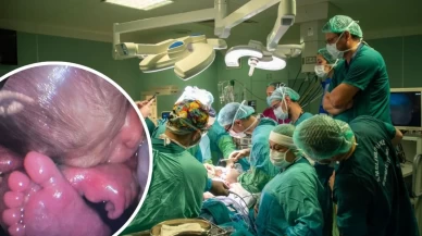 Anne karnındaki bebeğe kapalı yöntemle omurilik ameliyatı yapıldı