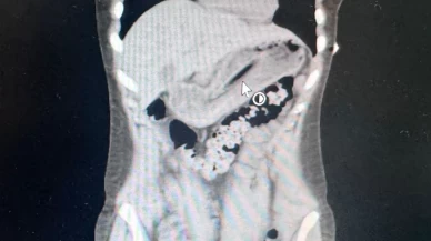 Kusmak için boğazına soktuğu diş fırçasını yuttu! Doktorlar bile inanamadı