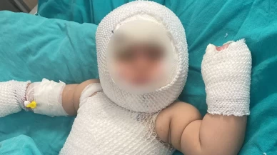 Mersin'de patlayan konserve Eliz bebeğin yüzünü yaktı!