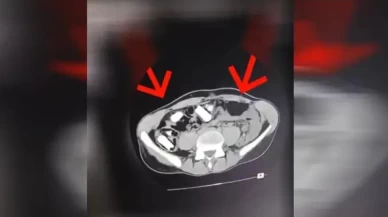 Erzincan'da mide ve bağırsaklarında metamfetamin ele geçirilen şüpheli tutuklandı