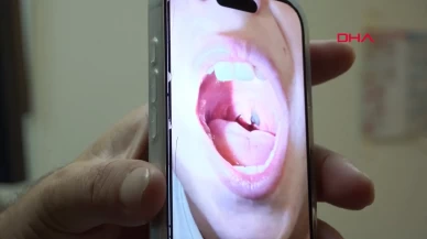 Çocuğun boğazından canlı sülük çıktı