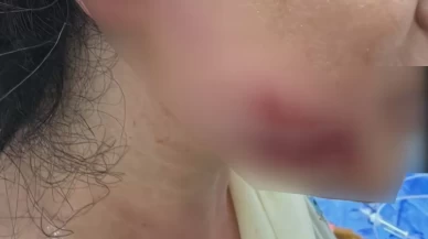 Balkondan giren havai fişek 2 kardeşi yaraladı!