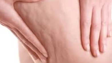Kadınların yüzde 90'ında görülüyor! İşte selülitin gizli nedenleri