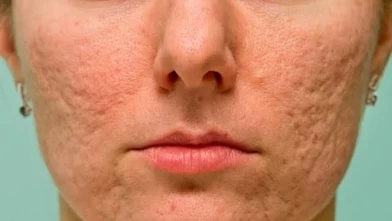 Delik görünümünü yok eden doğal çözüm