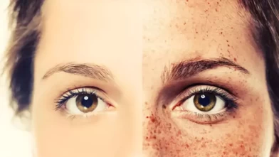 Doğal yöntemlerle çilleri azaltın! En etkili ev yapımı maske tarifi