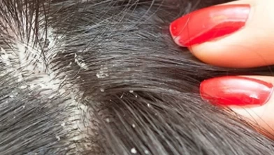 Kaşıntı ve kepek artışının az bilinen nedeni