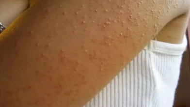 Nemlendirici yetmiyormuş!