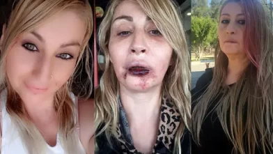 Dolgu sonrası dudağını kaybetti! 'Gülüşüm yok, yemek yiyemiyorum'