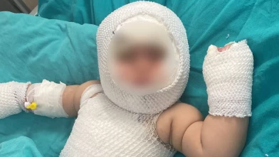Mersin'de patlayan konserve Eliz bebeğin yüzünü yaktı!