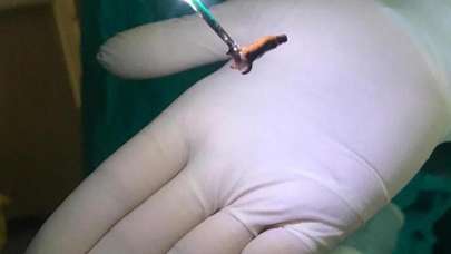 Nefes alamıyordu... Genç kadının akciğerinden çıkan şey şoke etti