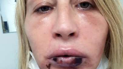 Güzellik uğruna hayatı karardı