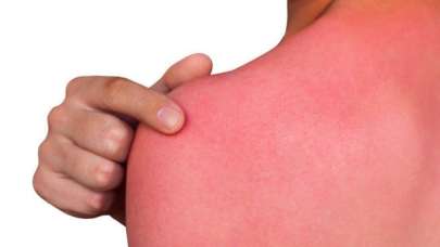 Güneş yanığına ne iyi gelir, ne sürülür? Güneş yanığı nasıl geçer, acısı nasıl azalır?