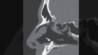 Tıkalı burnu muayene eden doktorlar ameliyat kararı aldı!