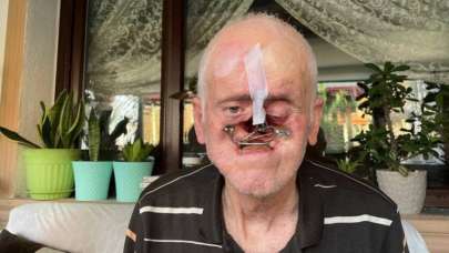 Burnu milim milim eridi