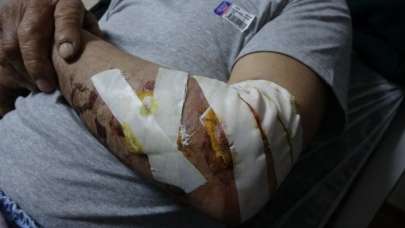 Başıboş köpek, yaşlı adamın kolunu bu hale getirdi!