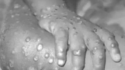 'Rusya maymun çiçeği virüsünü biyolojik silah olarak kullandı!'