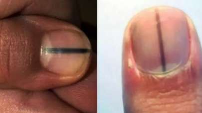 Tırnaklardaki siyah çizgilere dikkat: Uzmanı uyardı!
