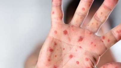 ABD sağlık uzmanları uyardı: Maymun çiçeği hastalığının tespiti zorlaştı