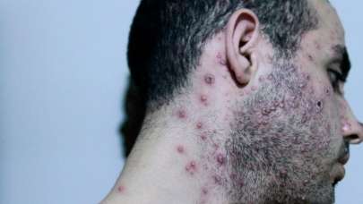 Maymun çiçeği virüsü İran'a da sıçradı!