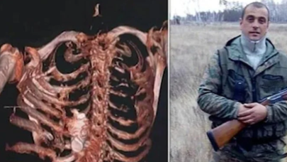 İnanılır gibi değil! Rus doktorlar şok oldu: Göğsünden patlamamış el bombası çıktı