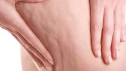 Kadınların yüzde 90'ında görülüyor! İşte selülitin gizli nedenleri