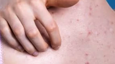 Milyonların kurtulamadığı soruna kalıcı çözüm!