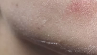 Kış aylarında aşırı kuru ciltler için bakım önerileri