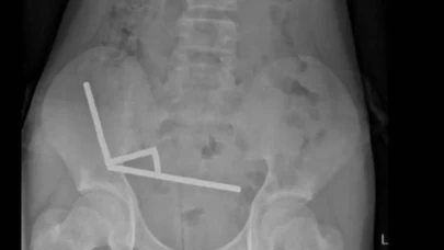 200 tane mıknatıs yuttu!