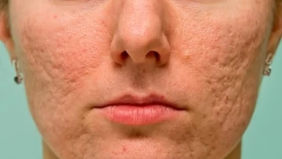 Delik görünümünü yok eden doğal çözüm