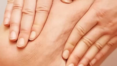 Selülit oluşumunu hızlandıran faktörler